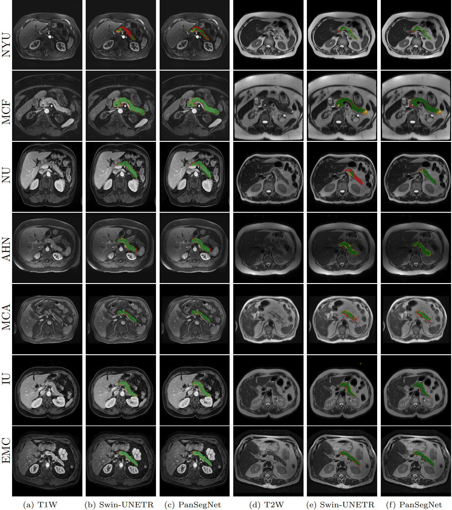 Qualitative Pancreas Segmentation Visualizations